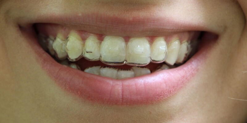 Zähne mit unsichtbare Zahnspange